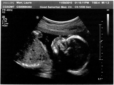 20 week ultrasound